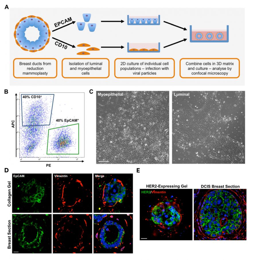Fig. 1. Isolated myoepithelial and luminal cells maintain their characteristics in vitro. A. Schematic of proposed ductal model. B. Representative FACS plots of reduction mammoplasty specimens separated by expression of CD10 (allophycocyanin fluorescence, blue gate) and epithelial cell adhesion molecule (EpCAM; phycoerythrin fluorescence, green gate). C. Representative light micrographs of isolated myoepithelial and luminal cells grown in vitro for 10 days. Images taken at × 4 original magnification. Scale bar = 100 μm. D. Spheroid structures formed in collagen gels recapitulate a physiological breast bilayer. Expression of EpCAM and vimentin spheroid (upper) structures formed from myoepithelial and luminal cells grown in collagen for 21 days. Representative images from sections of normal human breast ducts (lower panel) are also presented. Cell nuclei are labelled with 4′,6-diamidino-2-phenylindole (blue). Scale bar = 20 μm.  E. Overexpression of human epidermal growth factor receptor 2 (HER2) in the luminal compartment of a bilayer model results in destabilisation of the bilayer and luminal filling: HER2 and vimentin expression in representative HER2-expressing ductal spheroids (left) and ductal carcinoma in situ breast sections (right). Cell nuclei are labelled with DAPI (blue). Scale bar = 20 μm.