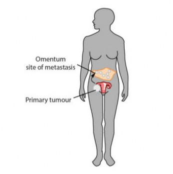 Schematic, ovarian cancer