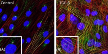 Cancer regulation of cilia