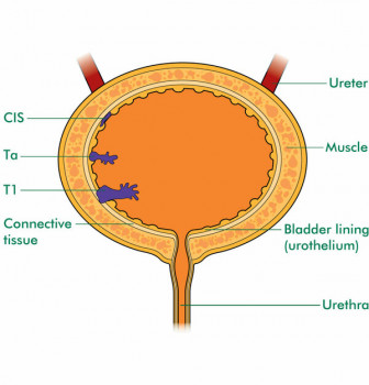 Staging of bladder cancer (https://www.macmillan.org.uk/)