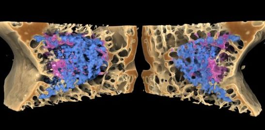 Bone graft material developed through predictive in vitro models at Queen Mary